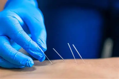 Dry Needling Therapy